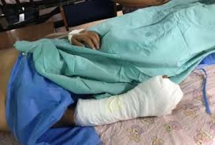 Niño pierde parte de la mano por explosión de petardo