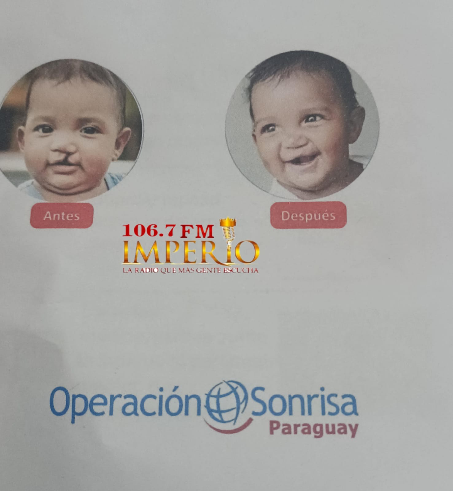 Exitosa cirugía a niño indígena con labio leporino