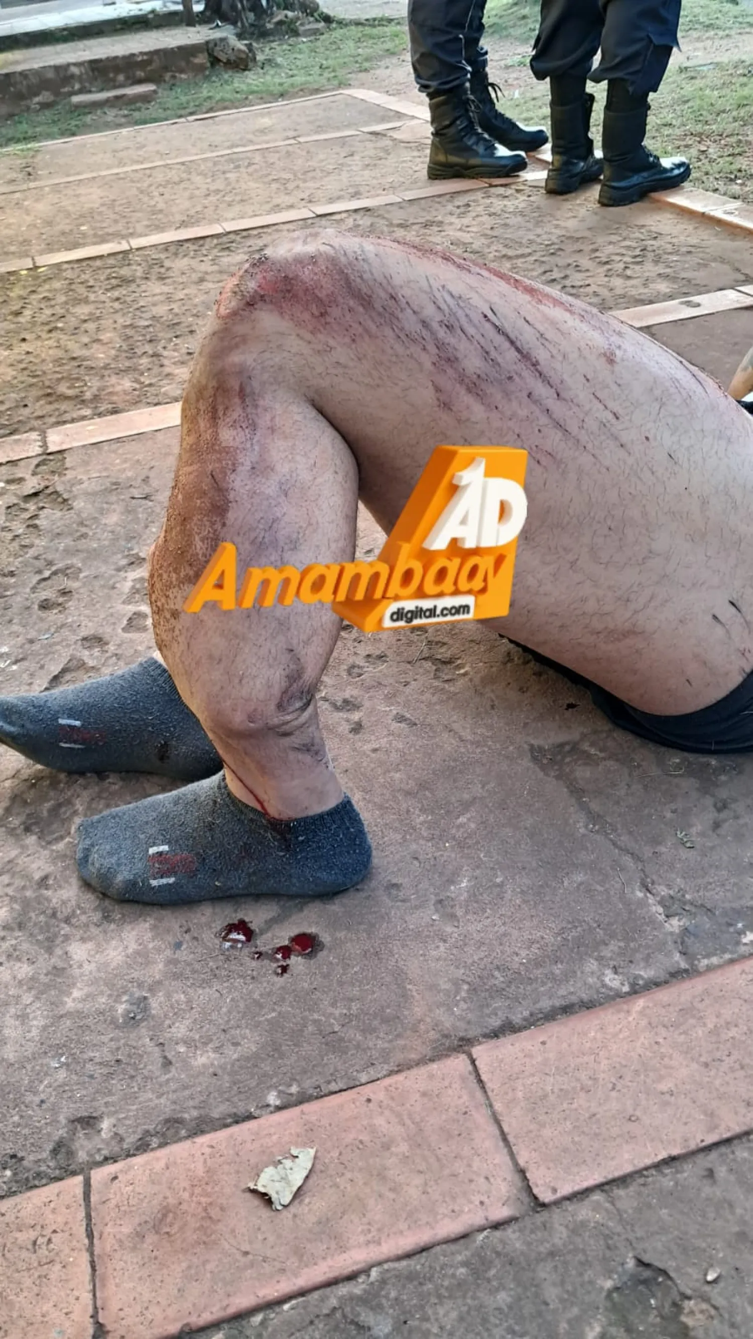 Motociclista sufre fractura expuesta tras chocar contra patrullera en Pedro Juan Caballero