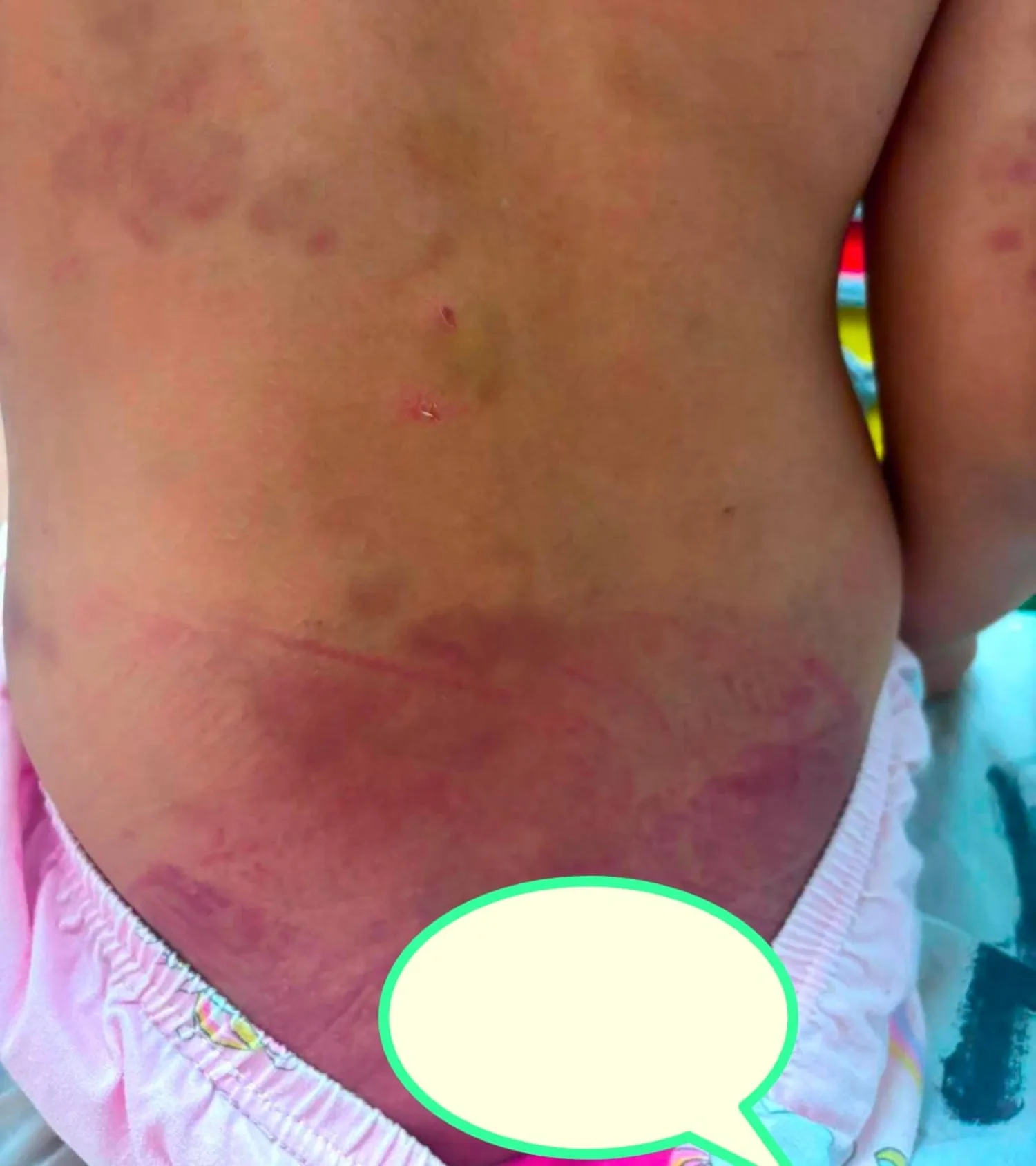 Niña de 6 años habría sido brutalmente agredida por su padrastro en Pedro Juan Caballero
