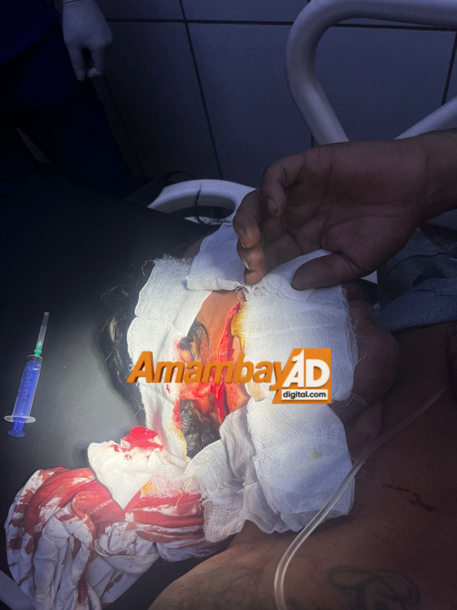 Llegó en su motocicleta al Hospital Regional con profunda herida en el rostro y afirma haber sido víctima de asalto